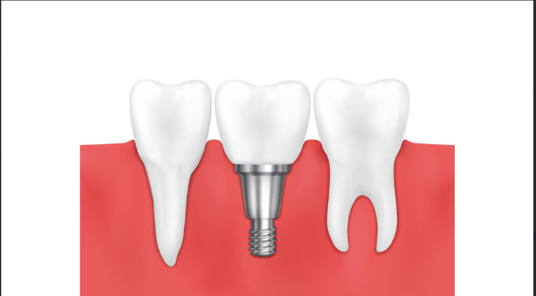 Lasting Dental Protection with Stainless Steel Crowns Lasting Dental Protection with Stainless Steel Crowns